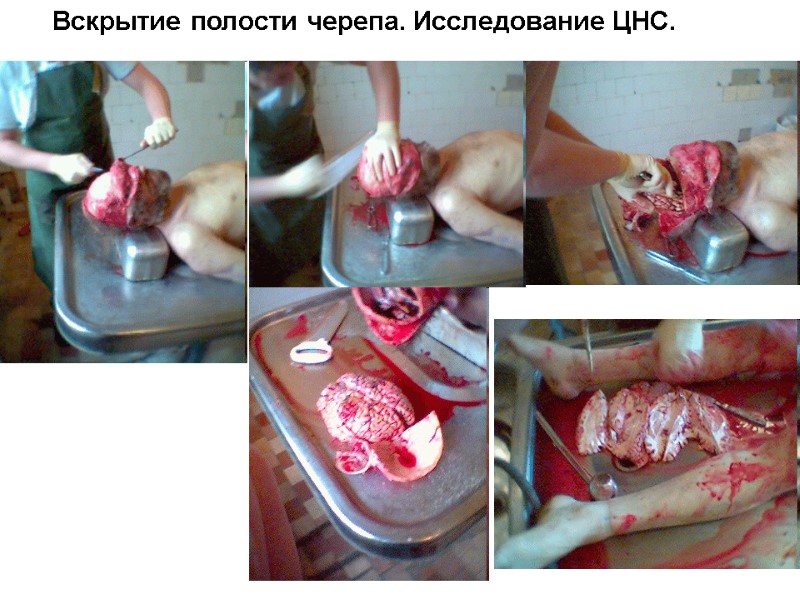 Вскрытие полости черепа. Исследование ЦНС.